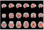 Radial diffusivity reflects general decline rather than specific cognitive deterioration in multiple sclerosis.