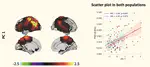Increased brain atrophy and lesion load is associated with stronger lower alpha MEG power in multiple sclerosis patients.